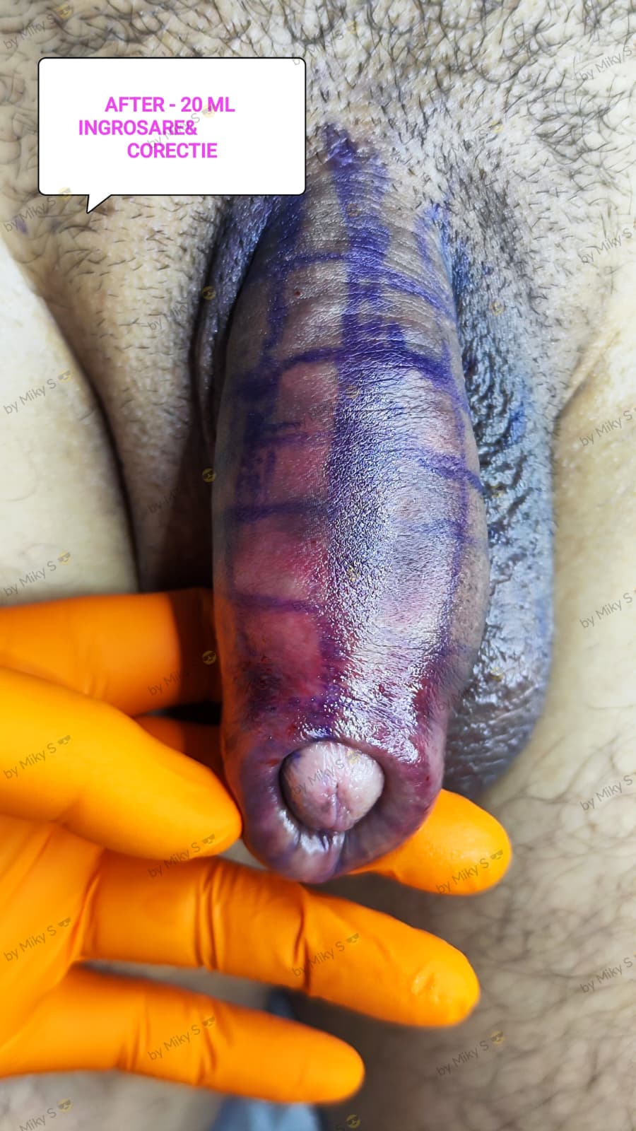 Îngroșare Genitală Masculină și Alungire Relativă cu Acid Hialuronic