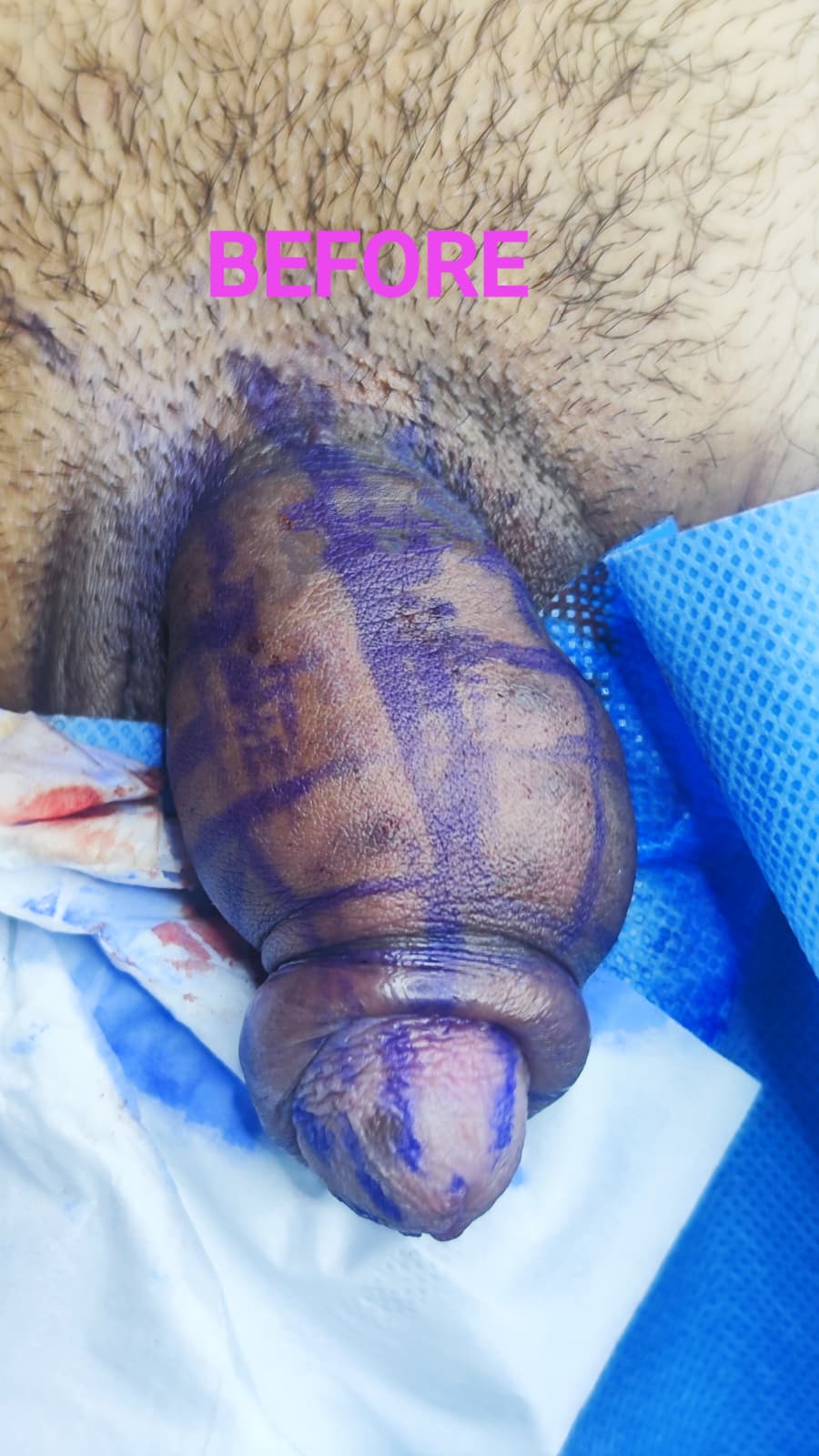 Îngroșare Genitală Masculină și Alungire Relativă cu Acid Hialuronic