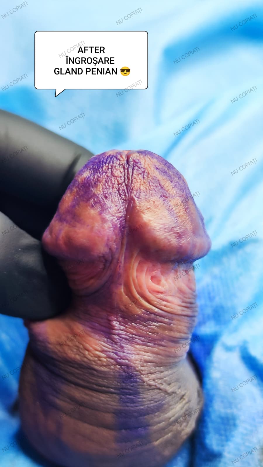 Îngroșare Genitală Masculină și Alungire Relativă cu Acid Hialuronic