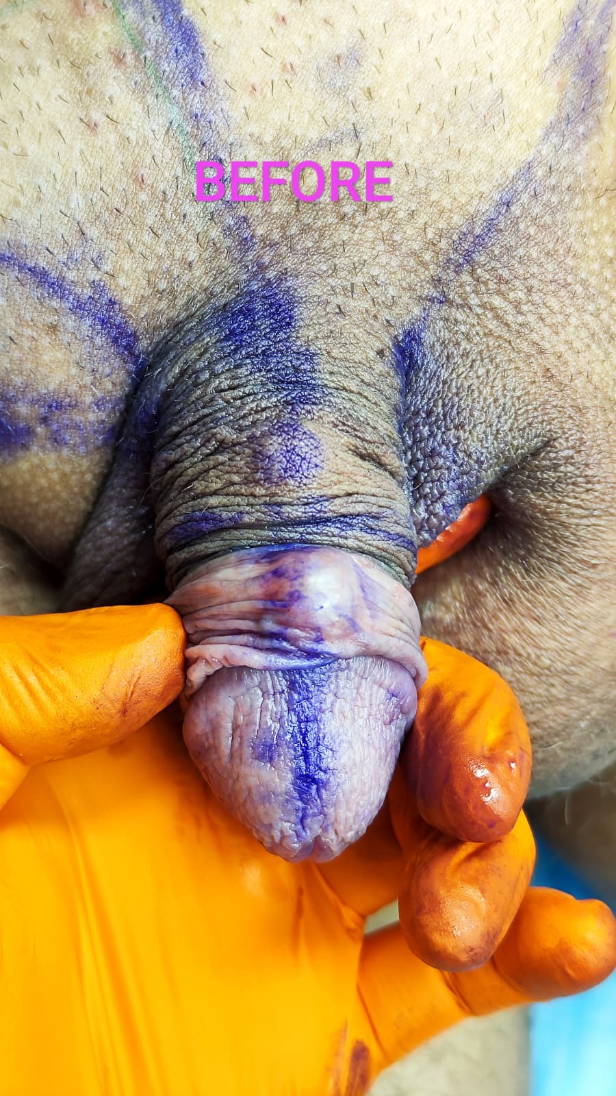Îngroșare Genitală Masculină și Alungire Relativă cu Acid Hialuronic