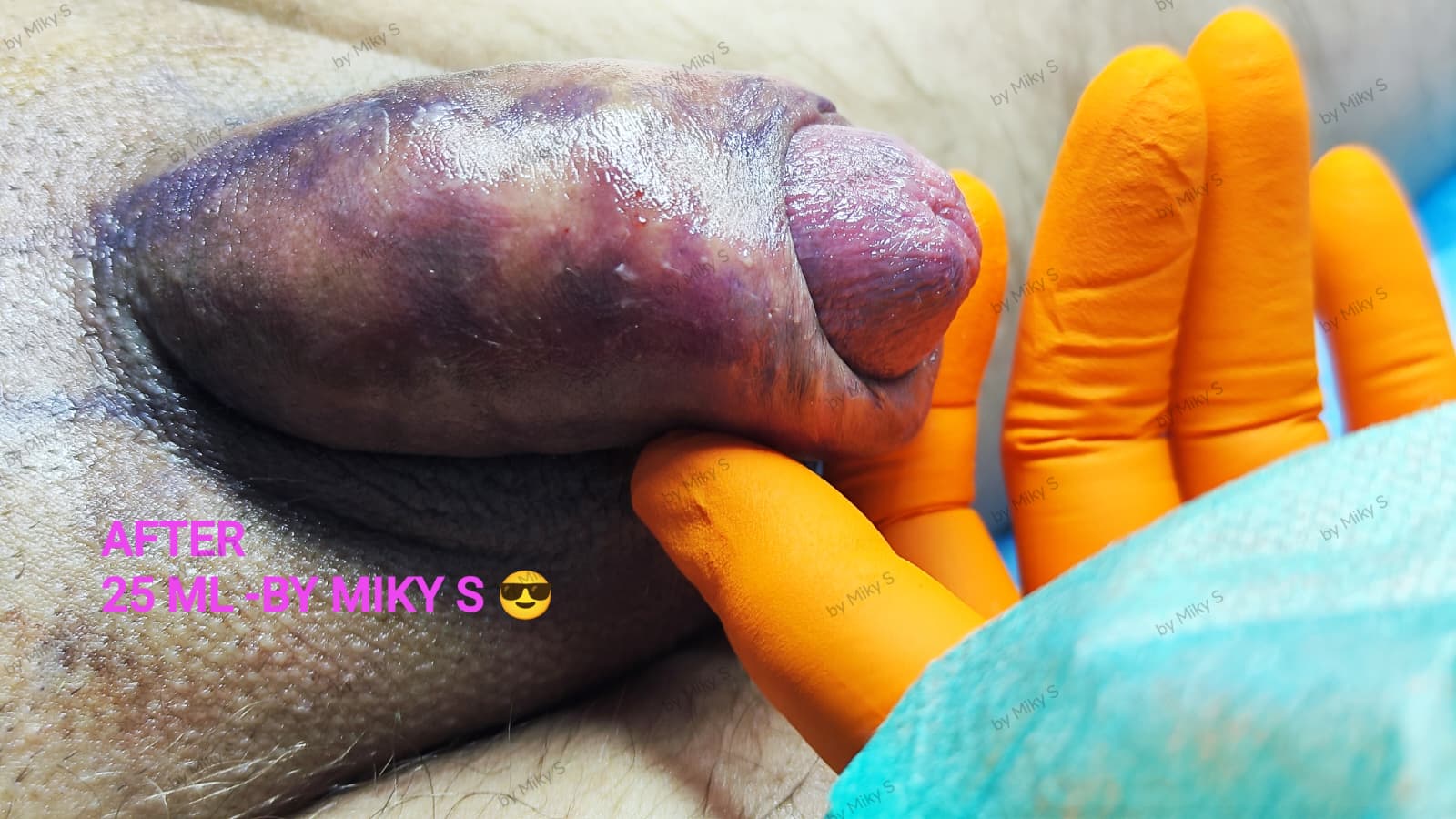 Îngroșare Genitală Masculină și Alungire Relativă cu Acid Hialuronic