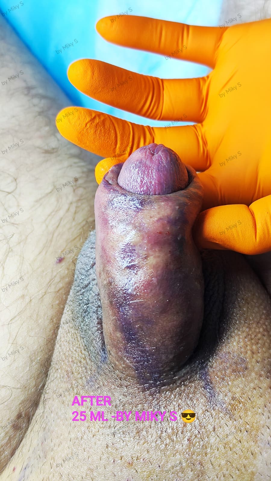 Îngroșare Genitală Masculină și Alungire Relativă cu Acid Hialuronic