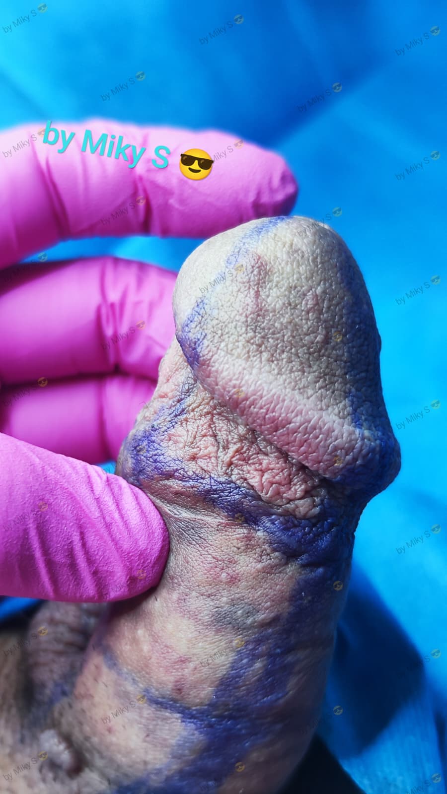 Îngroșare Genitală Masculină și Alungire Relativă cu Acid Hialuronic