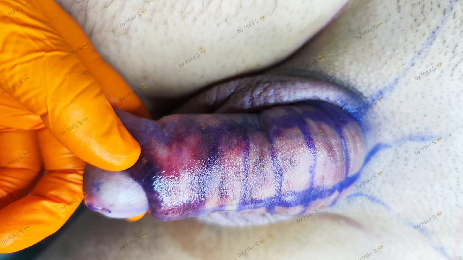 Îngroșare Genitală Masculină și Alungire Relativă cu Acid Hialuronic