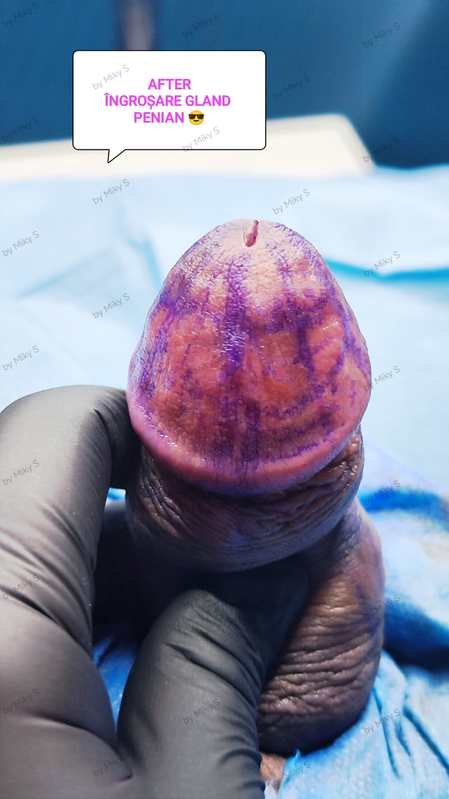 Îngroșare Genitală Masculină și Alungire Relativă cu Acid Hialuronic