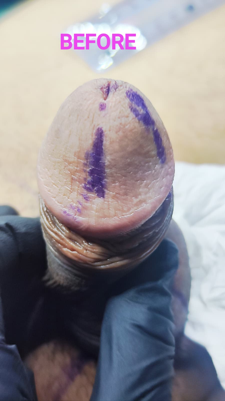 Îngroșare Genitală Masculină și Alungire Relativă cu Acid Hialuronic
